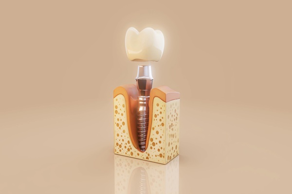 Top   Benefits Of Choosing Dental Implants For Missing Teeth