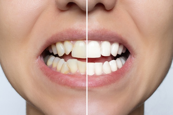 Cosmetic Dentistry Procedures For Teeth Whitening